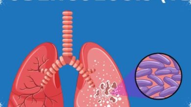 Garut Dihantui Tuberkulosis, 3.939 Kasus Terkonfirmasi dan 20 Orang Meninggal