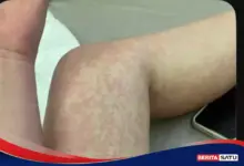 Penonton Tetap Datang Saat Campak, 3 Langkah Ini Harus Dicek Jika Anda Terpapar