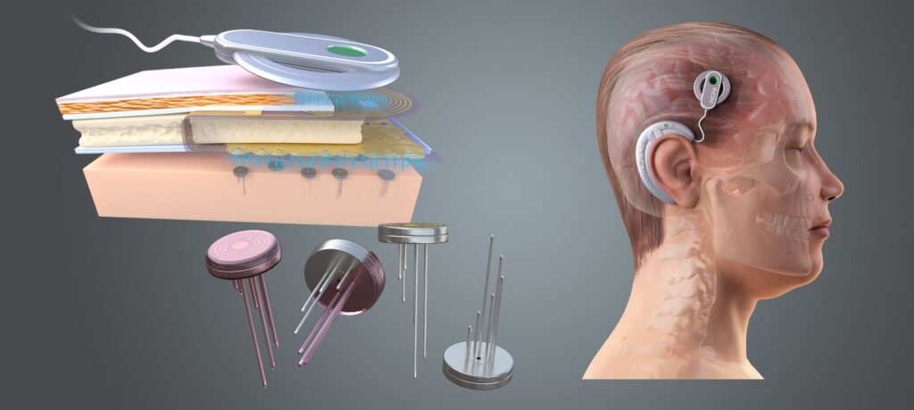 Brain Chip Senilai Koin Ini Bisa Bantu Lumpuh Bergerak Lagi, Tapi Datanya Sangat Sensitif