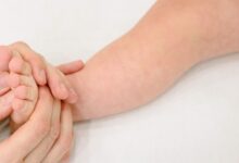 Skin Barrier Jadi Kunci, Cara Mencegah Eksim Bayi Kambuh di Tengah Kasus yang Meningkat
