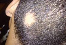 Scalp T-Zone Sering Dilupakan, Padahal Di Sini Rambut Mulai Menipis Duluan