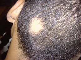 Scalp T-Zone Sering Dilupakan, Padahal Di Sini Rambut Mulai Menipis Duluan